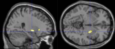 iDiet fMRI brain scans